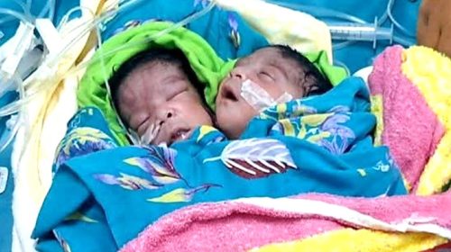 রাজশাহীতে দুটি মাথা নিয়ে শিশুর জন্ম