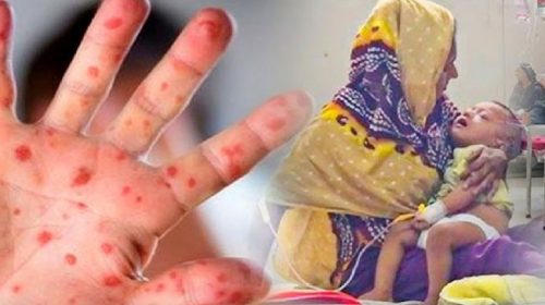 ২৪ ঘণ্টায় দেশে ৯৯০ সন্দেহজনক হাম রোগী শনাক্ত